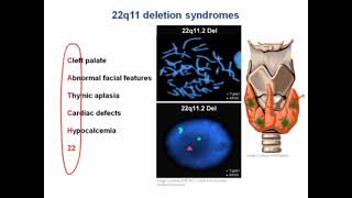 22Q11 Deletion Syndrome