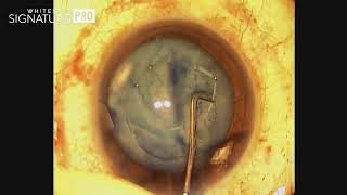 Laser Cataract Surgery with White Cataract