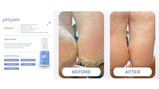 Lotion untuk mengatasi kaki pecah-pecah, kulit kaki kering dan menghalusian kulit kaki