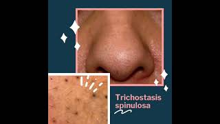 Treatment for black spots over nose/ Black heads or not? ( English)