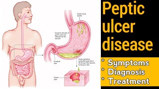 peptic ulcer disease|PUD|symptoms|diagnosis|treatment|medical knowledge pk