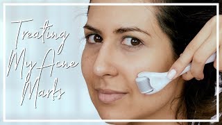 HOW TO REMOVE ACNE SCARS & HYPERPIGMENTATION | First Impressions Banish Kit | JASMINA PURI