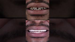 TEETH DONE IN TURKEY | VENEERS, CROWNS, IMPLANTS IN TURKEY | DENTIST IN TURKEY | 0090 555 564 40 07