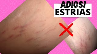 Como ELIMINE Las Fastidiosas Estrías❌LA VERDAD QUE NO TE QUIEREN DECIR❌|| MI HISTORIA REAL